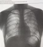 Снимок флюорографии с пневмонией фото 1