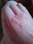 Красные волдыри на пальцах рук, на сгибе с тыльной стороны фото 3