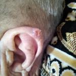 Как вылечить новообразование на наружной части уха фото 1