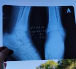 Осколок кости на рентгене фото 1