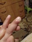 Болячка на пальце руки у ребенка фото 1