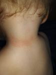 Сыпь на шее у ребенка фото 1