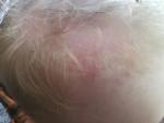 Красные пятна у ребёнка на волосистой части головы фото 4