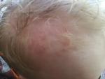Красные пятна у ребёнка на волосистой части головы фото 3