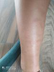 Красно- синие пятна на икрах ног фото 3