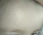 Сыпь на лбу, щеках и предплечье у ребенка фото 1