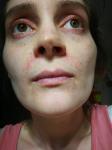 Хроническое покраснение кожи вокруг рта фото 3