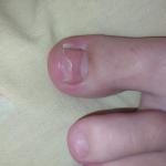 Отслоение ногтя от ногтевого ложа фото 1