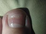 Отслоение ногтя от ногтевого ложа фото 2