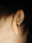 Красные пятна на мочке уха фото 3