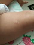 Аллергия у ребенка пятнами, будто реакция Манту фото 2