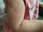 Аллергия у ребенка пятнами, будто реакция Манту фото 1