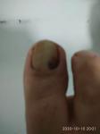 Коричневое пятно на ногте большого пальца ноги фото 2