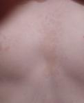 Сыпь на области груди фото 1