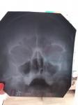 Рентгенограмма пазух носа. Описание фото 1