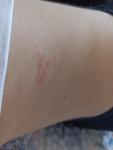 Высыпания на животе, аллергия при татуировке фото 2