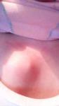 Шишка на грудной клетке у девочки 12 лет фото 2