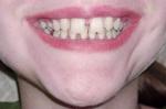 Кариес зубов фото 1