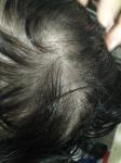 Зуд и выпадение волос фото 2
