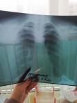 Рентген лёгких. Боль в грудине фото 2