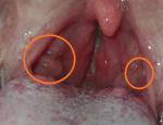 Воспаление горла, миндалины, белые гнойники фото 2