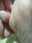 Бородавки на мезинце на ноге фото 1