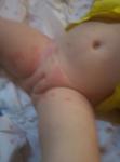Красная сыпь по всему телу у ребёнка фото 1