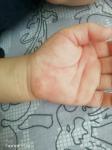 Красная сыпь на руках у ребенка фото 2