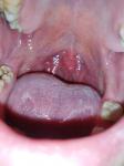 Хронический тонзиллит и сухость во рту фото 2