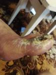Рана на большом пальце ноги после грибка фото 3