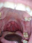 Хронический тонзиллит и сухость во рту фото 1
