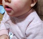Сыпь на щеках у ребенка 10 месяцев фото 1