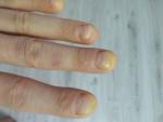 Проблема ногтей рук фото 4