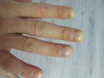 Проблема ногтей рук фото 3