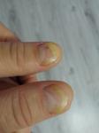 Проблема ногтей рук фото 1