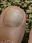 Пульсация на пальце ноги, синева под ногтем фото 1
