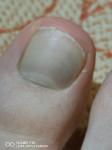 Пульсация на пальце ноги, синева под ногтем фото 2