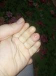 Воспалился палец у ребенка после взятия крови фото 1