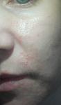 Гнойничковая сыпь на лице и гормональная мазь фото 1