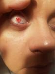Кровяное пятно на глазном яблоке фото 1