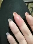 Опухший палец после простуды, с которого слезает кожа фото 1