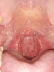 Болит горло, тонзилит и фарингит фото 3