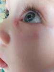 Шишка возле глаза у ребенка фото 1