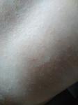 Периодические высыпания на коже у ребенка фото 2