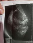 Беременностт или миома фото 2