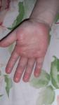 Сыпь на ладошках у ребенка 3 года фото 1