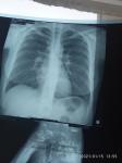 Воспаление лёгких на рентгене фото 1