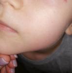 Мелкая сыпь на теле ребёнка фото 1
