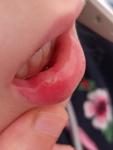 Белое пятно на внутренней стороне губы фото 2