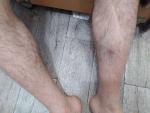 Тромбоз подколенного сустава. Почернение ноги фото 2